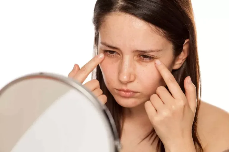 Understanding and Managing Dark Eye Circles